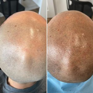 image d'un crâne tatoué par micropigmentation capillaire par DERMA-INK à Besançon.