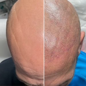 image d'un crâne tatoué par micropigmentation capillaire par DERMA-INK à Besançon.